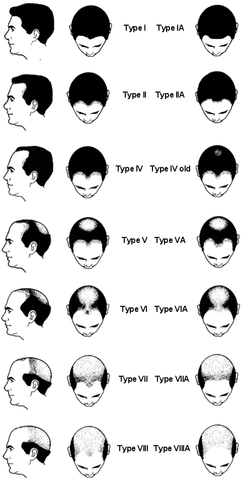 Male Pattern Baldness