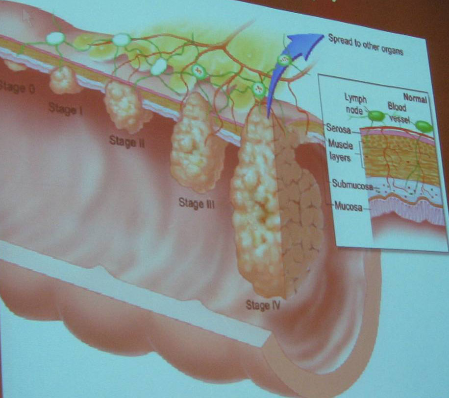 Clogged Stools And Colorectal Cancer