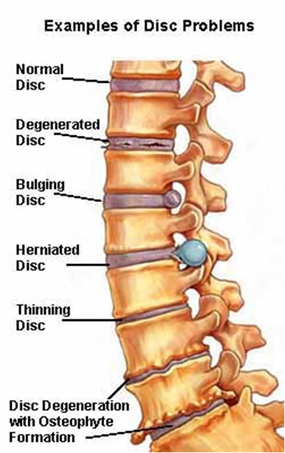 Problems of Spinal Disks